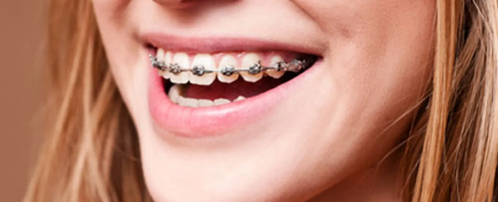 4 Great Benefits of Short-term Adult Braces | Lincroft, NJ