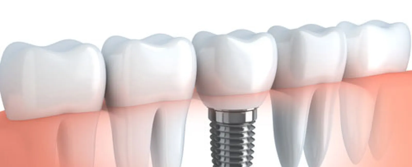 6 Reasons You’ll Love Dental Implants